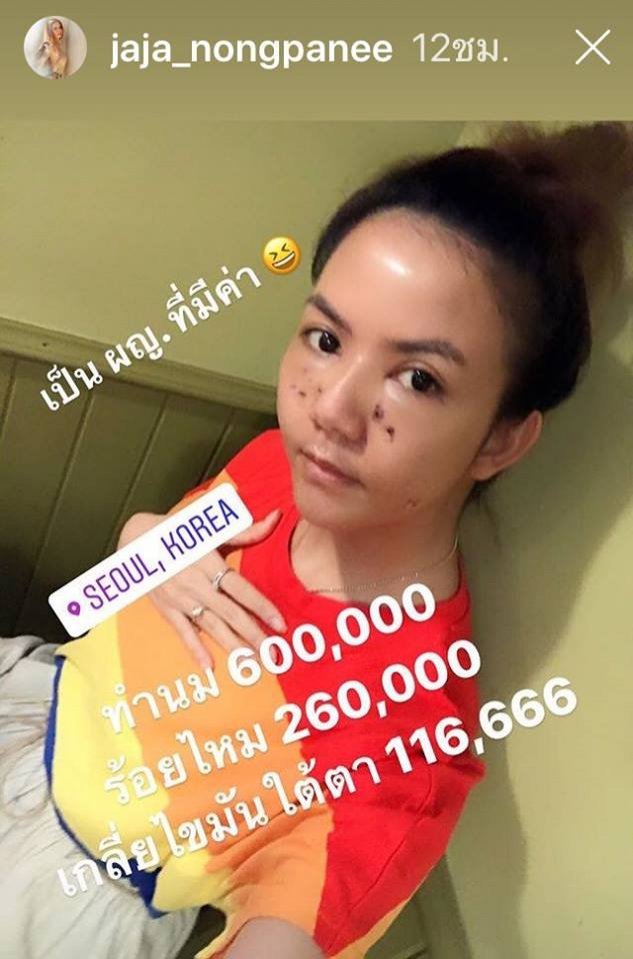 เผยราคาศัลยกรรม ของจ๊ะ ทำทั้งหน้า-หน้าอก หมดไปกี่บาท – Beauty In Thai เผยราคาศัลยกรรม ของจ๊ะ ทำทั้งหน้า-หน้าอก หมดไปกี่บาท – Beauty In Thai
