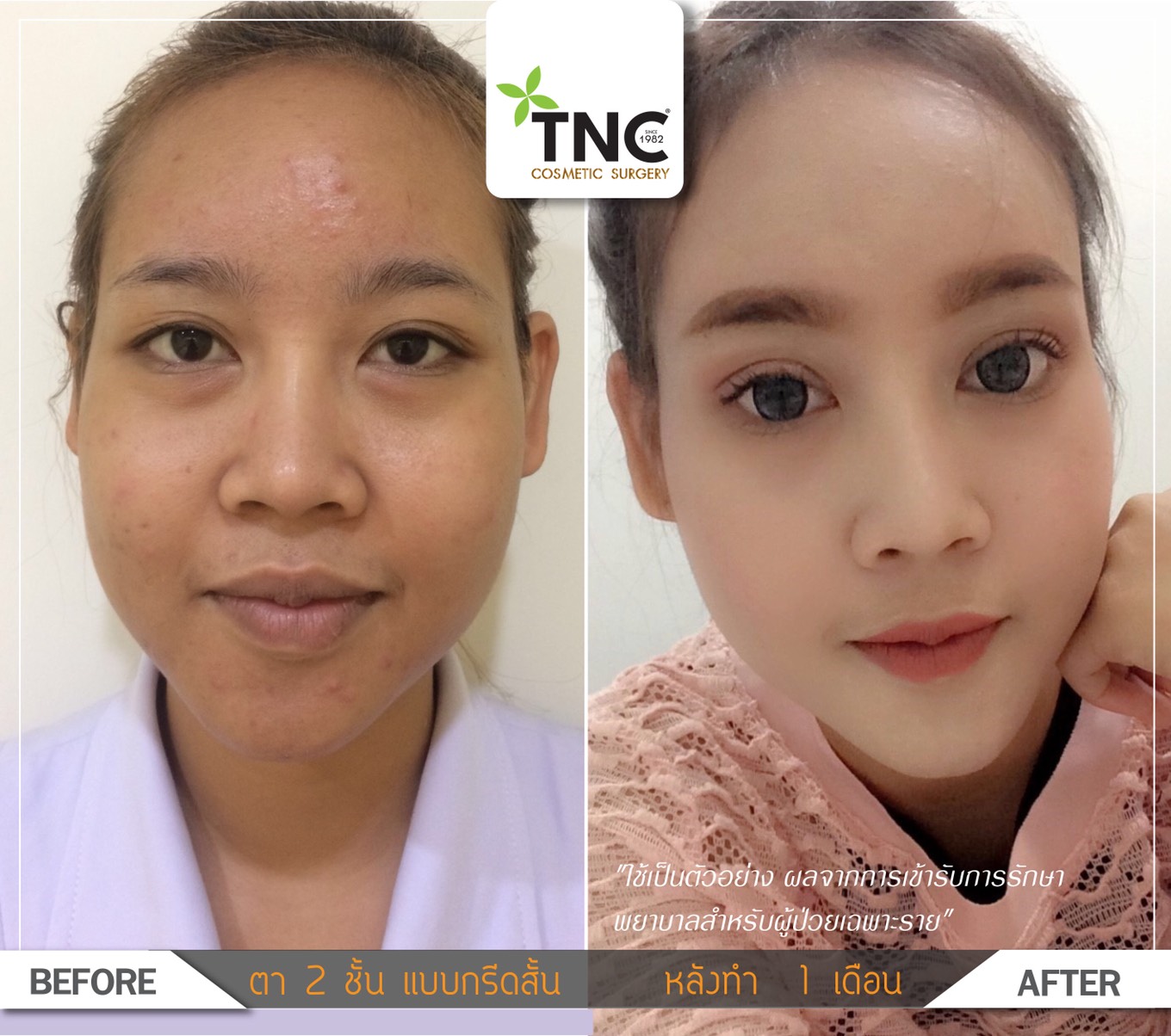 ศัลยกรรมตาสองชั้น Eye Lids Surgery ชั้นตาชัด เส้นคมโค้งสวย Beauty In Thai
